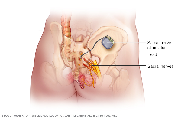 Implanted nerve stimulation device